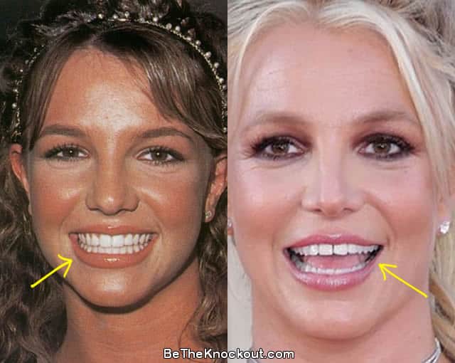 chuck adams recommends britney braces pic